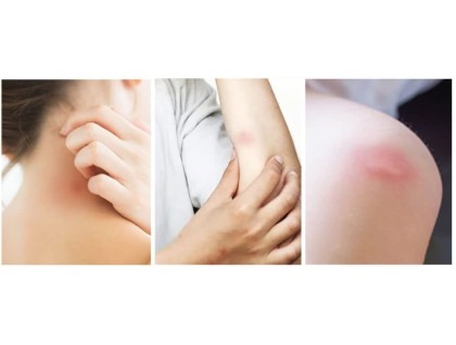 Itch Relief Plus ointment for itch, rash and insect bites